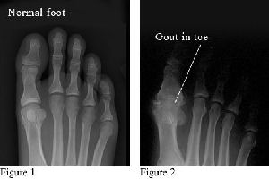 Gout in toe